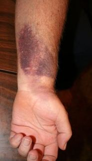 diagnosis differential forearm photoree